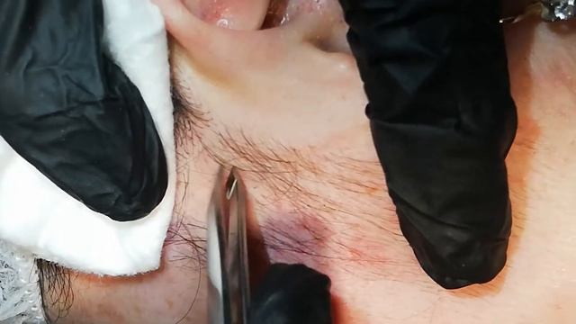 Электроэпиляция вольфрамовой нитью. Лицо. смотреть онлайн