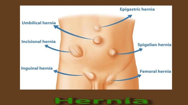 Lump In Groin: Causes And Treatment смотреть онлайн