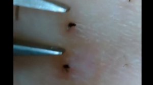 Убираем вросшие волосы