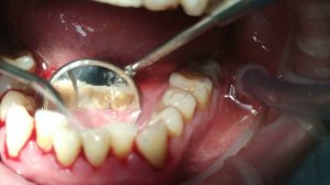 Удаление зубного камня ультразвуком (скалер) / Dental plaque