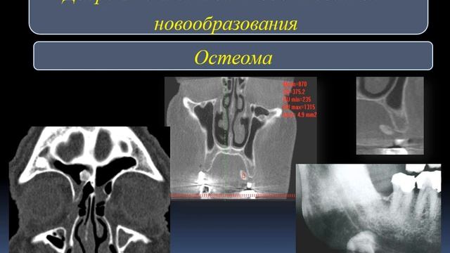 Занятие № 7 Лучевая диагностика кист и новообразований челюстно-лицевой области смотреть онлайн
