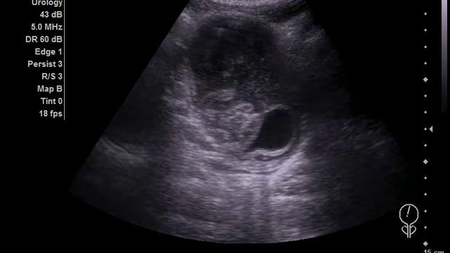 Образование мочевого пузыря. Введение катетера. смотреть онлайн