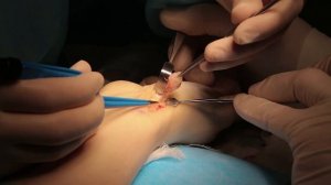 Удаление объемного образования -гигромы