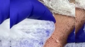 Прыщи давить залипательное 😵💫🤤ЧТО КРУЧЕ : прыщ или чёрная точка?пиши в комментах