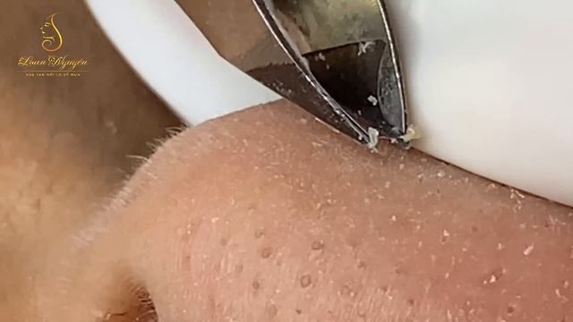 Satisfying With Loan Nguyen Spa Video (#061) #acnetreatment смотреть онлайн