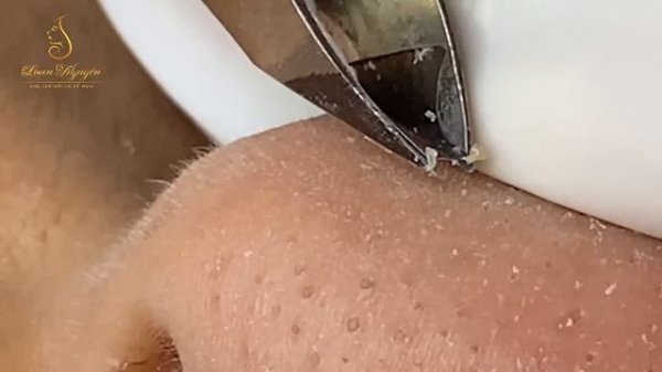 Satisfying With Loan Nguyen Spa Video (#061) #acnetreatment