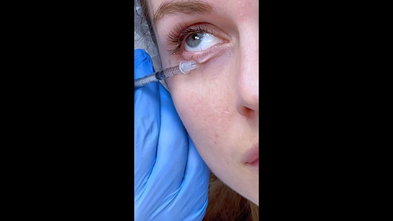 Секретные техники ботулинотерапии смотреть онлайн