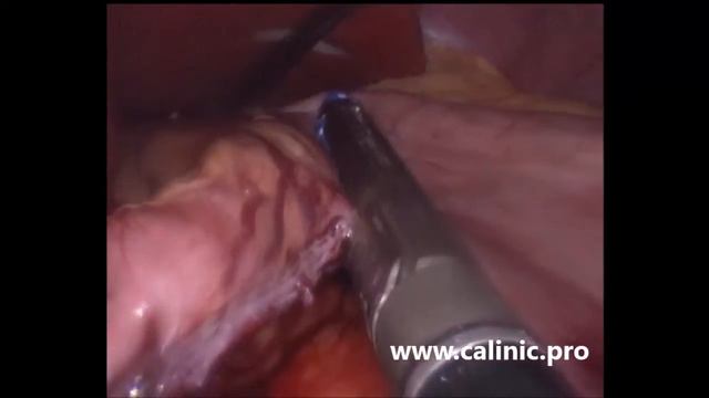 Лапароскопическая продольная резекция желудка смотреть онлайн