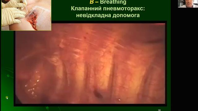 Лекция Повреждения и травмы грудной клетки. проф. В.Д.Шейко смотреть онлайн