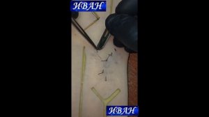 Удаление шва по Донати с помощью скальпеля?