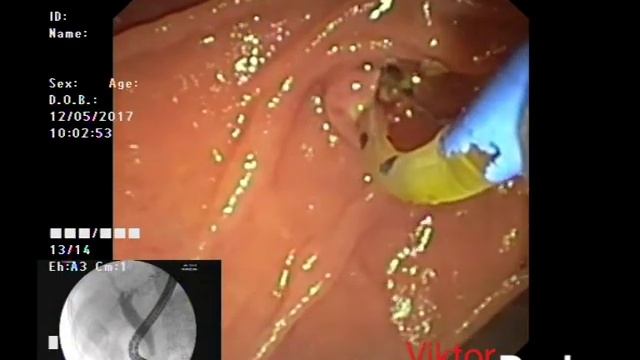 РХПГ (ERCP) смотреть онлайн