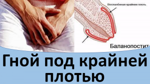 Гной под крайней плотью.