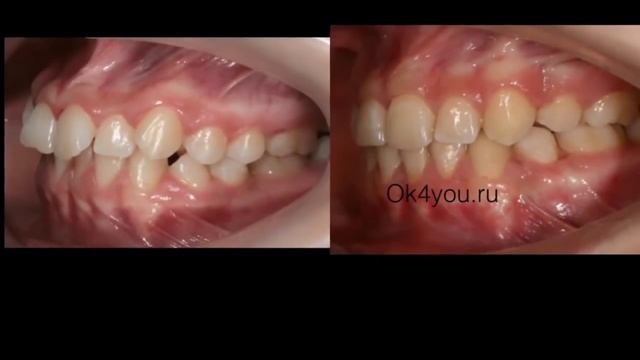 Ортодонтическое исправление положения клыков смотреть онлайн