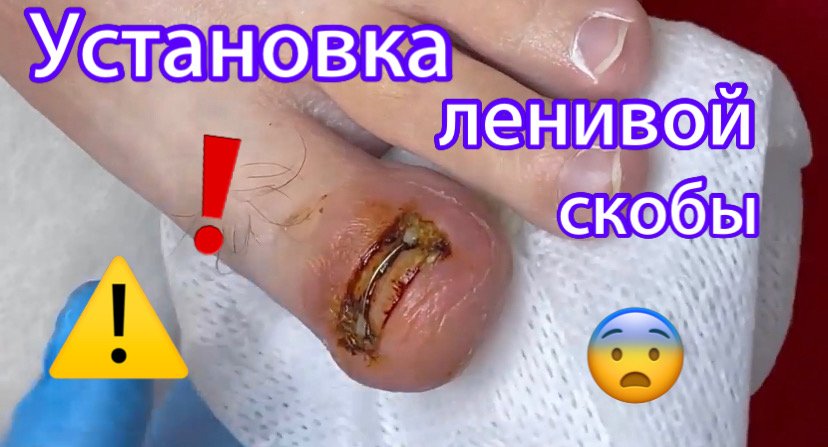 Установка ленивой скобы?⚠️❗️?? смотреть онлайн