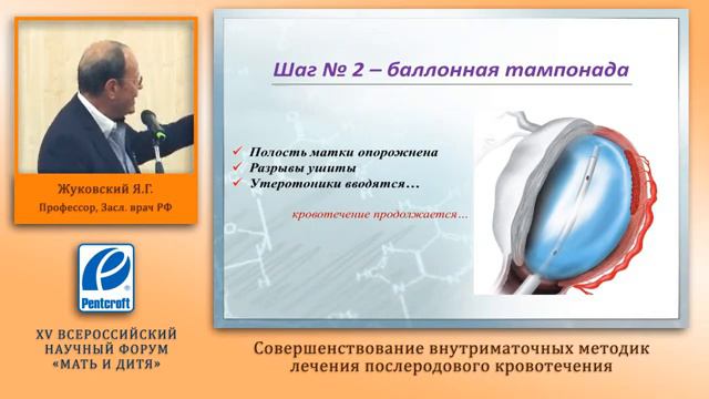 Послеродовое кровотечения совершенствование внутриматочных методик заслврач ЯГ Жуковский смотреть онлайн