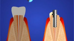 Восстановление зуба на штифте