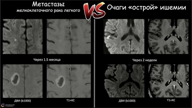 Вебинар МРО РОРР: Метастазы в головной мозг много лиц одного процесса