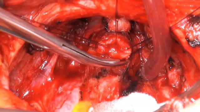 nns Radical Retropubic Prostatectomy смотреть онлайн