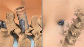 Amazing Surgery To Fix Curved Spine Scoliosis Animation смотреть онлайн