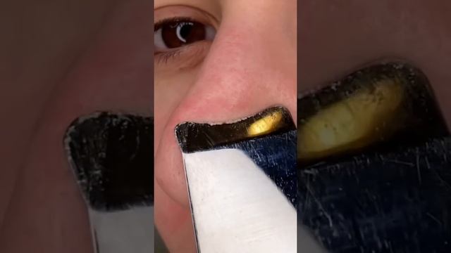 Чистка лица дома. Убираю прыщи и чёрные точки. САМА СЕБЕ КОСМЕТОЛОГ смотреть онлайн