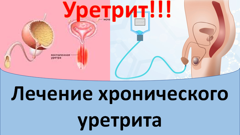 Лечение хронического уретрита смотреть онлайн