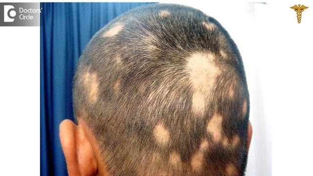Can one use Fluocinolone lotion to stop hair fall? - Dr. Sudheendra Udbalker смотреть онлайн