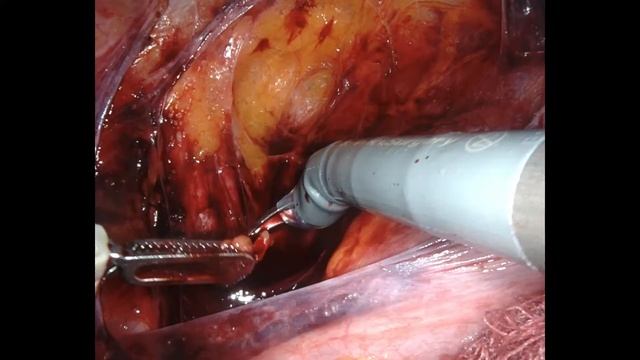 Sentinel lymph node detection with indocyanine green (ICG) - Endometrial cancer - Robotic approach смотреть онлайн