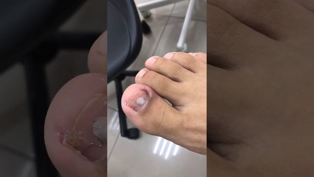 Установка титановой нити - Результат