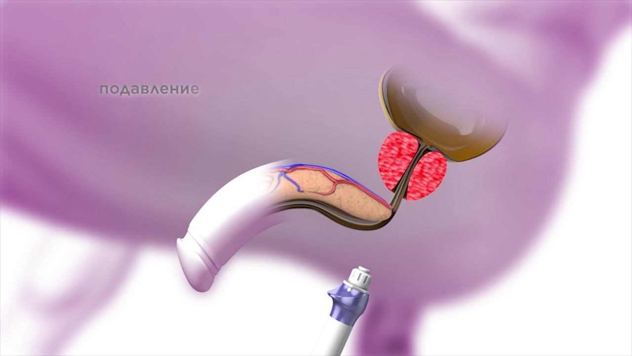 Ударно-волновая терапия BTL при лечении простатита. Визуализация. смотреть онлайн
