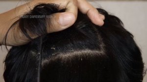 Удаление огромных чешуек перхоти в домашних условиях #899