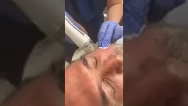 Virtue RF Microneedling Treatment