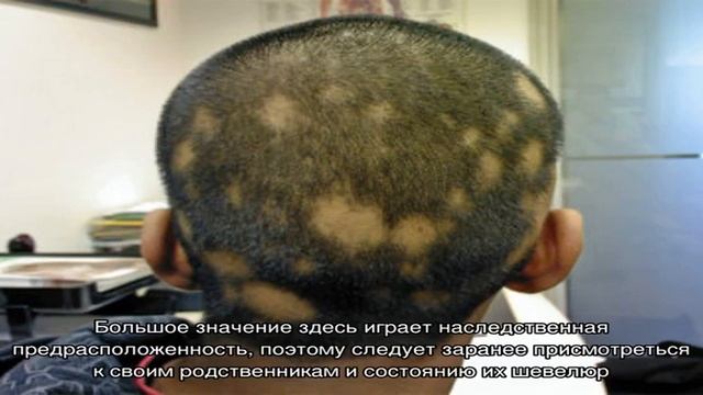 Выпадение волос: причины и лечение смотреть онлайн