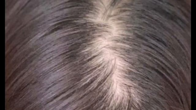 МАСКИРОВКА КАМУФЛЯЖ ЛЫСИН, ЗАЛЫСИН, ПРОСВЕТОВ - ПРОПЛЕШИН, ПРОБОРОВ, ШРАМОВ У МУЖЧИН И ЖЕНЩИН смотреть онлайн