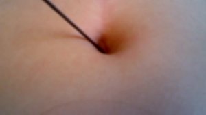 опирация пупка