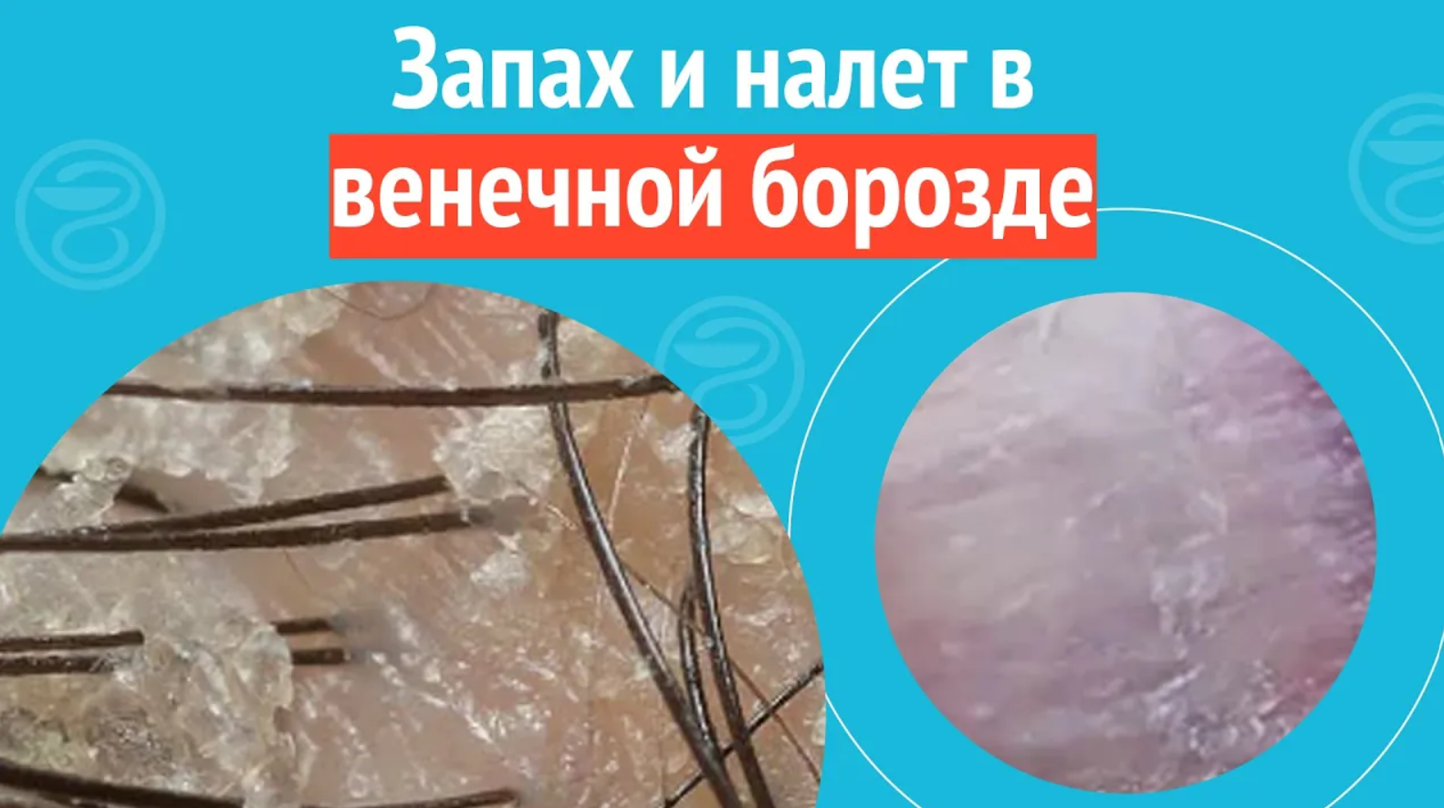➡️ Запах и налет в венечной борозде. Клинический случай №1150