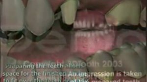 Как ставляются мосты на зубы.