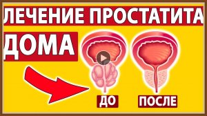 ЛЕЧЕНИЕ ПРОСТАТИТА НАРОДНЫМИ СРЕДСТВАМИ