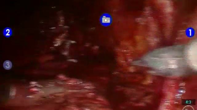 Robotic Radical Cystectomy with Extended Pelvic Lymph Node Dissection смотреть онлайн