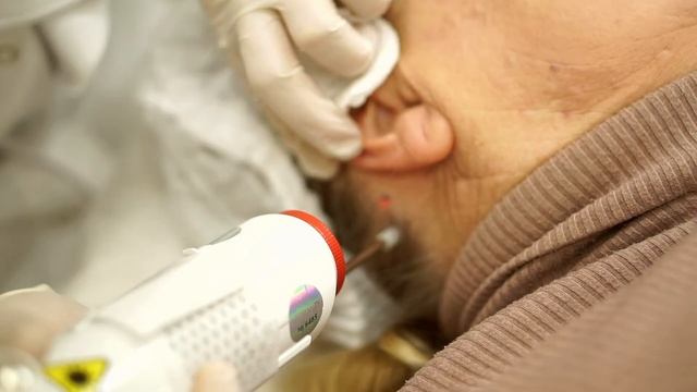 Лазерное удаление новообразований. смотреть онлайн