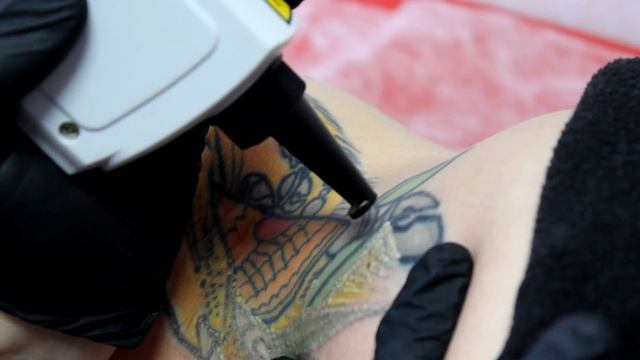 Процесс удаления контура татуировки Челябинск смотреть онлайн