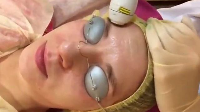 Процедура лазерной шлифовки лица с помощью насадки Palomar Lux 1540 в клинике Эскулап Архангельск смотреть онлайн