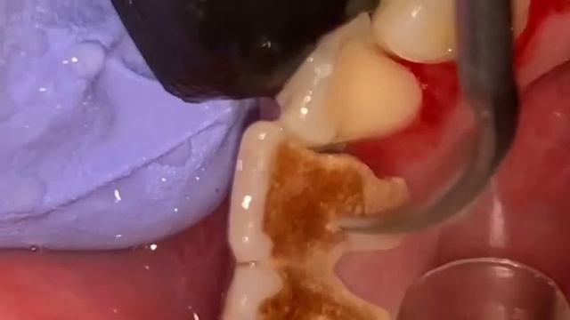 Зубной камень в 20 лет- Dental Plaque Сleaning смотреть онлайн
