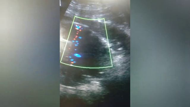 Расслаивающая аневризма брюшной аорты смотреть онлайн
