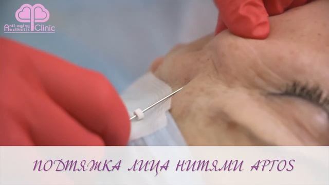 Установка нитей для подтяжки лица