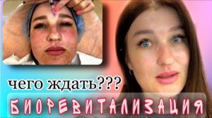 Биоревитализация лица. До и После. Уколы красоты. Омоложение  #биоревитализация#косметология