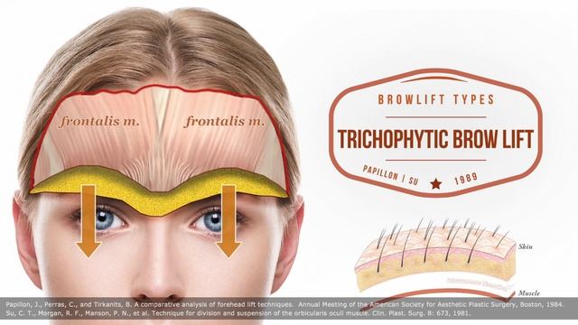 Brow Lift 101 : Differences between brow lifting techniques - Part II | Aesthetic Minutes #Browlift смотреть онлайн