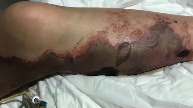 【剃毛之恐】私处剃毛半条命没了，为了美请三思而后行#郑郑得证