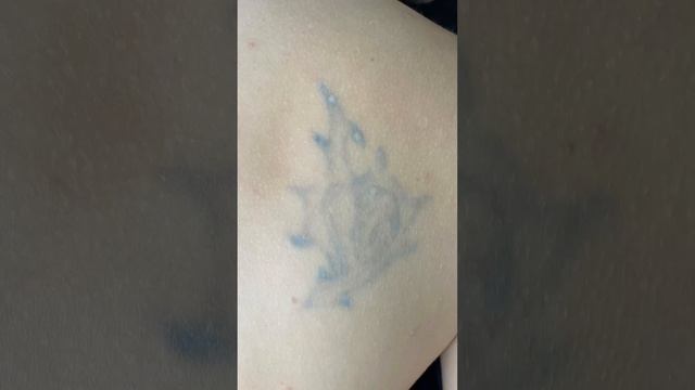 Подписывайся на наш канал, здесь всё о #лазерноеудалениетату смотреть онлайн