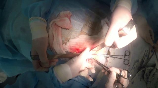 Аппендэктомия лапаротомия по Волковичу Дьякову смотреть онлайн