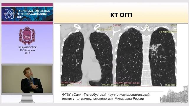 П.В. Гаврилов - Туберкулез у больных с ВИЧ-инфекцией. Разбор клинического случая. смотреть онлайн